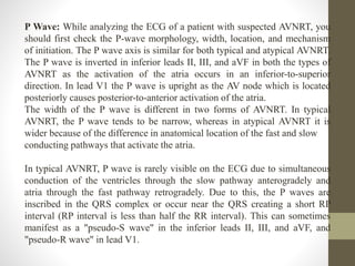 P Wave: While analyzing the ECG of a patient with suspected AVNRT, you
should first check the P-wave morphology, width, location, and mechanism
of initiation. The P wave axis is similar for both typical and atypical AVNRT.
The P wave is inverted in inferior leads II, III, and aVF in both the types of
AVNRT as the activation of the atria occurs in an inferior-to-superior
direction. In lead V1 the P wave is upright as the AV node which is located
posteriorly causes posterior-to-anterior activation of the atria.
The width of the P wave is different in two forms of AVNRT. In typical
AVNRT, the P wave tends to be narrow, whereas in atypical AVNRT it is
wider because of the difference in anatomical location of the fast and slow
conducting pathways that activate the atria.
In typical AVNRT, P wave is rarely visible on the ECG due to simultaneous
conduction of the ventricles through the slow pathway anterogradely and
atria through the fast pathway retrogradely. Due to this, the P waves are
inscribed in the QRS complex or occur near the QRS creating a short RP
interval (RP interval is less than half the RR interval). This can sometimes
manifest as a "pseudo-S wave" in the inferior leads II, III, and aVF, and
"pseudo-R wave" in lead V1.
 