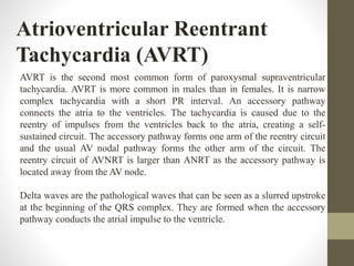 Atrioventricular Reentrant
Tachycardia (AVRT)
AVRT is the second most common form of paroxysmal supraventricular
tachycardia. AVRT is more common in males than in females. It is narrow
complex tachycardia with a short PR interval. An accessory pathway
connects the atria to the ventricles. The tachycardia is caused due to the
reentry of impulses from the ventricles back to the atria, creating a self-
sustained circuit. The accessory pathway forms one arm of the reentry circuit
and the usual AV nodal pathway forms the other arm of the circuit. The
reentry circuit of AVNRT is larger than ANRT as the accessory pathway is
located away from the AV node.
Delta waves are the pathological waves that can be seen as a slurred upstroke
at the beginning of the QRS complex. They are formed when the accessory
pathway conducts the atrial impulse to the ventricle.
 