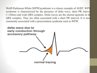 Wolff-Parkinson-White (WPW)syndrome is a classic example of AVRT. WPW
syndrome is characterized by the presence of delta wave, short PR interval
(<120ms) and wide QRS complex. Delta waves are the slurred upstroke in the
QRS complex. They are often associated with a short PR interval. It is most
commonly associated with a preexcitation syndrome such as WPW.
 