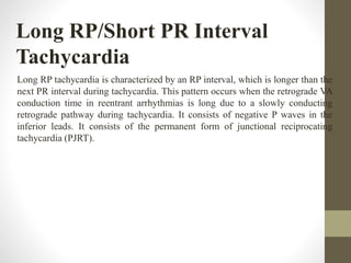 Long RP/Short PR Interval
Tachycardia
Long RP tachycardia is characterized by an RP interval, which is longer than the
next PR interval during tachycardia. This pattern occurs when the retrograde VA
conduction time in reentrant arrhythmias is long due to a slowly conducting
retrograde pathway during tachycardia. It consists of negative P waves in the
inferior leads. It consists of the permanent form of junctional reciprocating
tachycardia (PJRT).
 