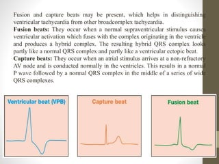 Fusion and capture beats may be present, which helps in distinguishing
ventricular tachycardia from other broadcomplex tachycardia.
Fusion beats: They occur when a normal supraventricular stimulus causes
ventricular activation which fuses with the complex originating in the ventricle
and produces a hybrid complex. The resulting hybrid QRS complex looks
partly like a normal QRS complex and partly like a ventricular ectopic beat.
Capture beats: They occur when an atrial stimulus arrives at a non-refractory
AV node and is conducted normally in the ventricles. This results in a normal
P wave followed by a normal QRS complex in the middle of a series of wide
QRS complexes.
 