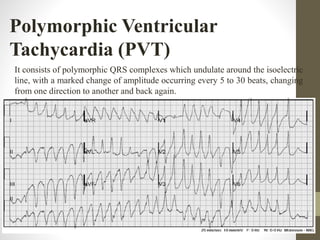 Polymorphic Ventricular
Tachycardia (PVT)
It consists of polymorphic QRS complexes which undulate around the isoelectric
line, with a marked change of amplitude occurring every 5 to 30 beats, changing
from one direction to another and back again.
 