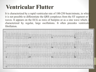 Ventricular Flutter
It is characterized by a rapid ventricular rate of 180-250 beats/minute, in which
it is not possible to differentiate the QRS complexes from the ST segment or T
waves. It appears on the ECG as rows of hairpins or as a sine wave which, is
characterized by regular, large oscillations. It often precedes ventricular
fibrillation.
 