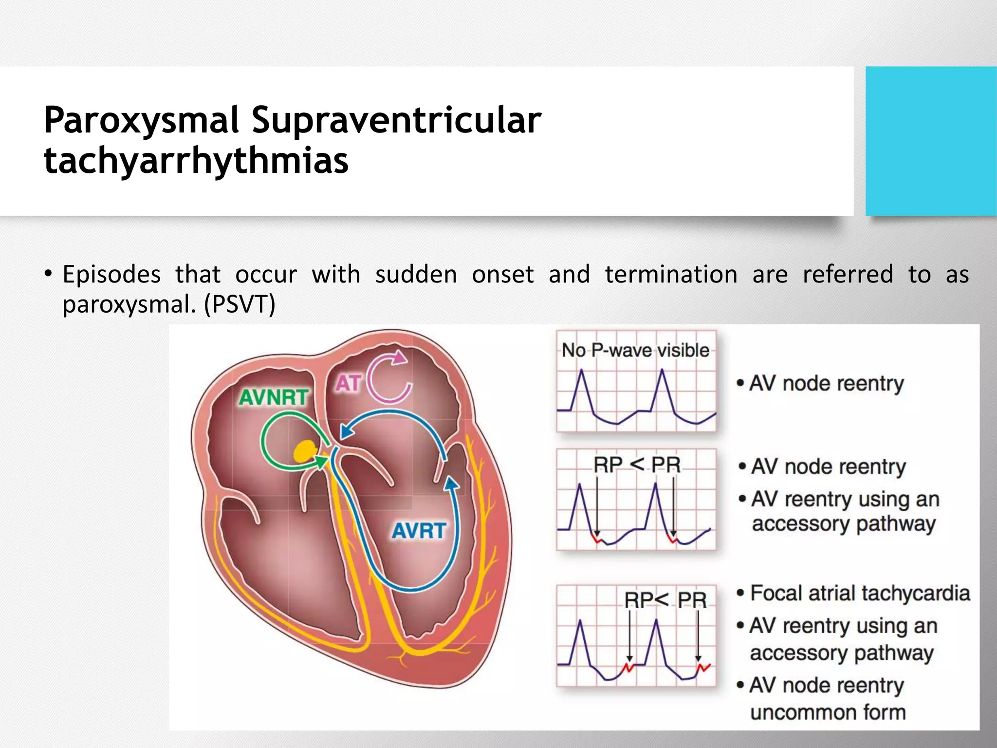 Paroxysmal Supraventricular
tachyarrhythmias
• Episodes that occur with sudden onset and termination are referred to as
paroxysmal. (PSVT)
 