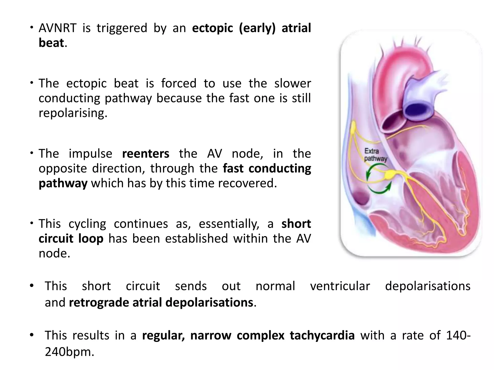  AVNRT is triggered by an ectopic (early) atrial
beat.
 The ectopic beat is forced to use the slower
conducting pathway because the fast one is still
repolarising.
 The impulse reenters the AV node, in the
opposite direction, through the fast conducting
pathway which has by this time recovered.
 This cycling continues as, essentially, a short
circuit loop has been established within the AV
node.
• This short circuit sends out normal ventricular depolarisations
and retrograde atrial depolarisations.
• This results in a regular, narrow complex tachycardia with a rate of 140-
240bpm.
 