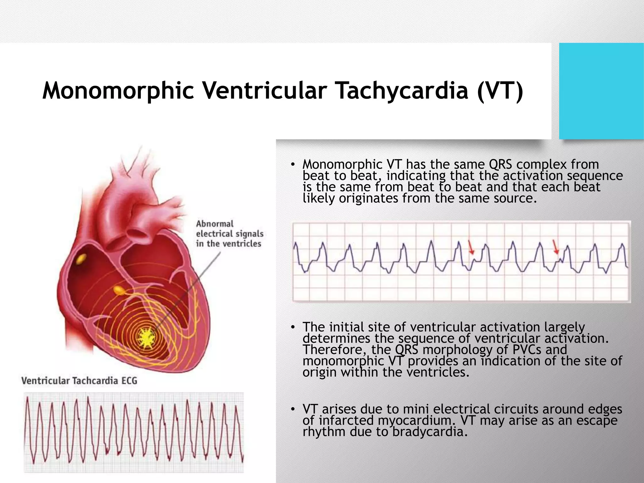 Monomorphic Ventricular Tachycardia (VT)
• Monomorphic VT has the same QRS complex from
beat to beat, indicating that the activation sequence
is the same from beat to beat and that each beat
likely originates from the same source.
• The initial site of ventricular activation largely
determines the sequence of ventricular activation.
Therefore, the QRS morphology of PVCs and
monomorphic VT provides an indication of the site of
origin within the ventricles.
• VT arises due to mini electrical circuits around edges
of infarcted myocardium. VT may arise as an escape
rhythm due to bradycardia.
 