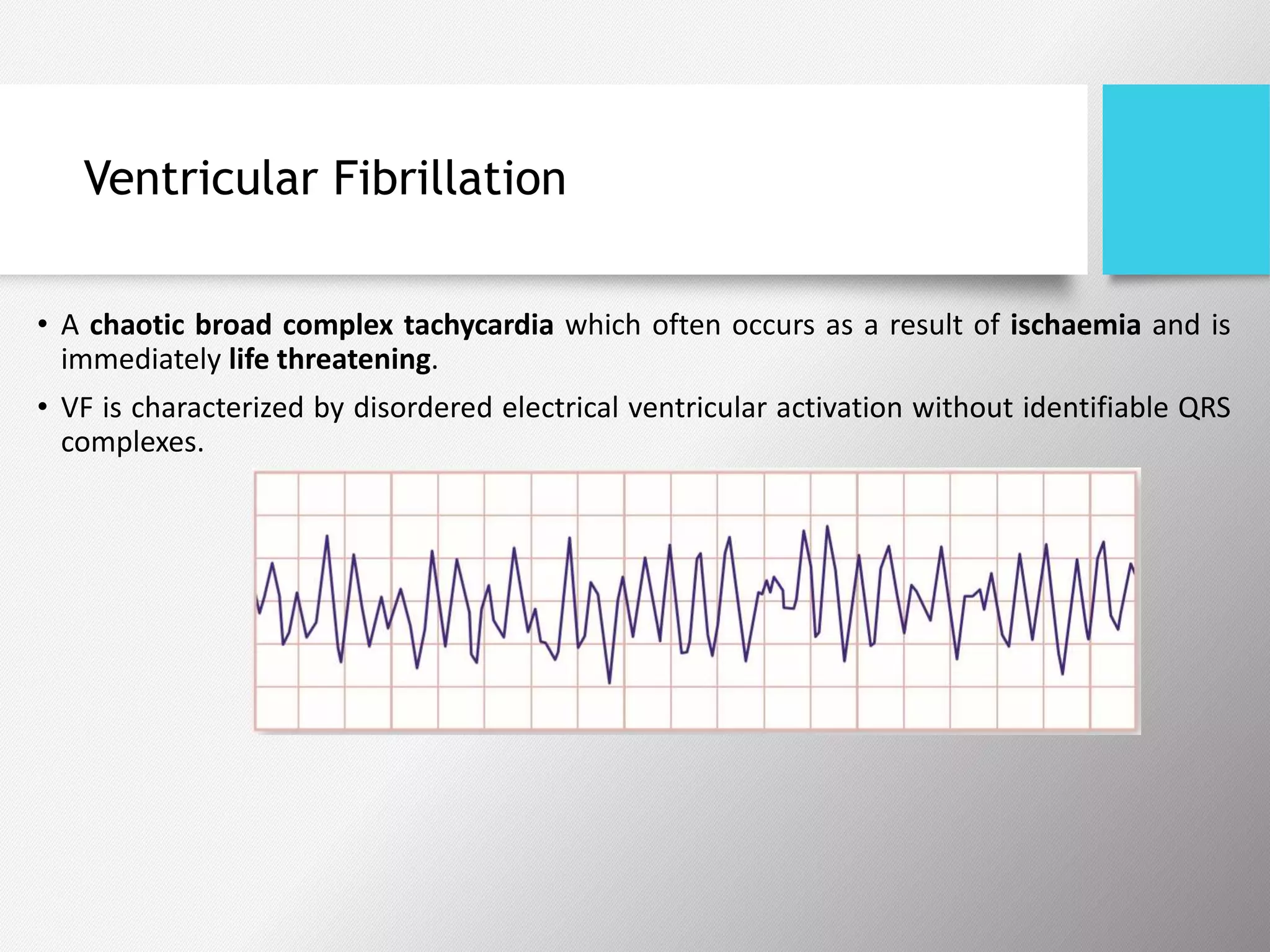 Ventricular Fibrillation
• A chaotic broad complex tachycardia which often occurs as a result of ischaemia and is
immediately life threatening.
• VF is characterized by disordered electrical ventricular activation without identifiable QRS
complexes.
 