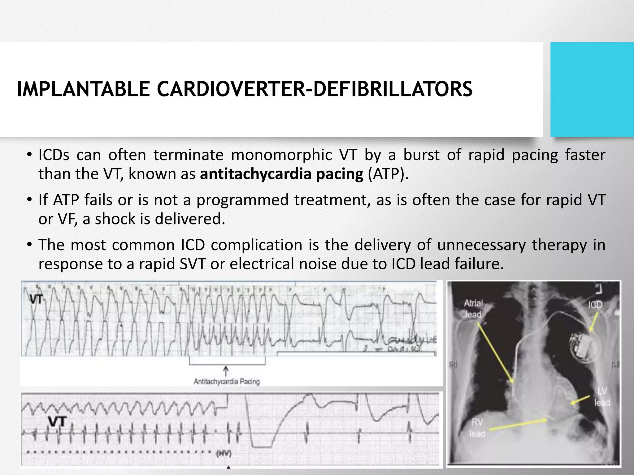 IMPLANTABLE CARDIOVERTER-DEFIBRILLATORS
• ICDs can often terminate monomorphic VT by a burst of rapid pacing faster
than the VT, known as antitachycardia pacing (ATP).
• If ATP fails or is not a programmed treatment, as is often the case for rapid VT
or VF, a shock is delivered.
• The most common ICD complication is the delivery of unnecessary therapy in
response to a rapid SVT or electrical noise due to ICD lead failure.
 