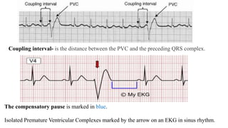 Tachyarrhythmias my | PPTX