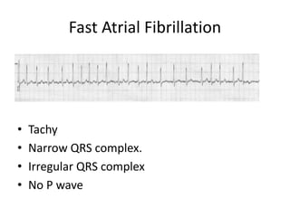 Tachy Fast Drawing Tachyarrythmia ecg | PPTX