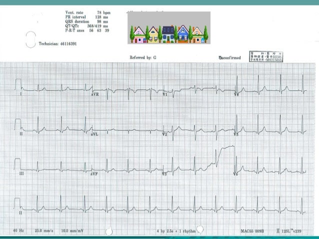 Arrhythmia Ecg Tachycardia 1916 南區