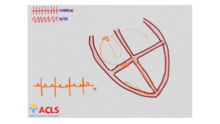 Tachycardias Introduction Whiteboard by ACLS Certification Institute 