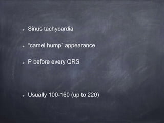 Sinus tachycardia
“camel hump” appearance
P before every QRS
Usually 100-160 (up to 220)
 