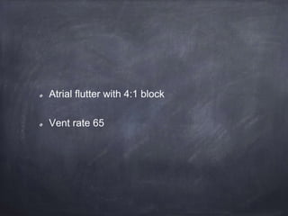 Atrial flutter with 4:1 block
Vent rate 65
 