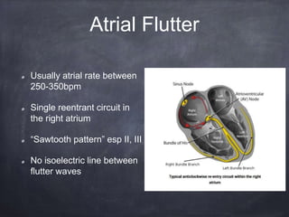 Usually atrial rate between
250-350bpm
Single reentrant circuit in
the right atrium
“Sawtooth pattern” esp II, III
No isoelectric line between
flutter waves
Atrial Flutter
 
