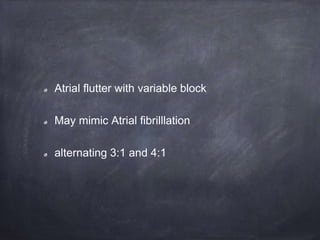 Atrial flutter with variable block
May mimic Atrial fibrilllation
alternating 3:1 and 4:1
 