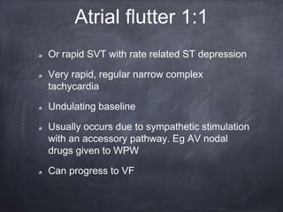 Or rapid SVT with rate related ST depression
Very rapid, regular narrow complex
tachycardia
Undulating baseline
Usually occurs due to sympathetic stimulation
with an accessory pathway. Eg AV nodal
drugs given to WPW
Can progress to VF
Atrial flutter 1:1
 