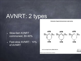 AVNRT: 2 types
Slow-fast AVNRT :
commonest, 80-90%
Fast-slow AVNRT : 10%
of AVNRT
 