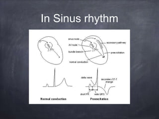 In Sinus rhythm
 