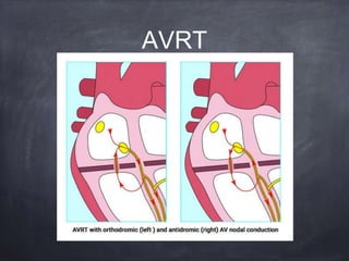 AVRT
 