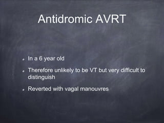 Antidromic AVRT
In a 6 year old
Therefore unlikely to be VT but very difficult to
distinguish
Reverted with vagal manouvres
 