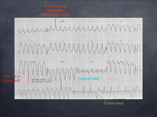 Capture beat
And -ve in
III and aVF
Extreme axis
deviation.
QRS +ve in aVR
Fusion beat
 