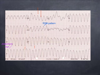 Josephson
sign
RSR pattern
 