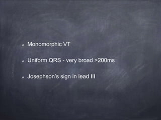 Monomorphic VT
Uniform QRS - very broad >200ms
Josephson’s sign in lead III
 