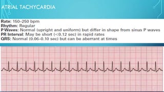 ATRIAL TACHYCARDIA
 