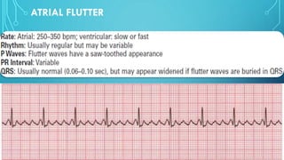 ATRIAL FLUTTER
 