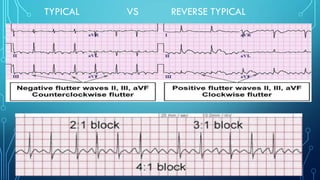 TYPICAL VS REVERSE TYPICAL
 