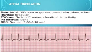 ATRIAL FIBRILLATION
 