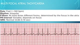 MULTI FOCAL ATRIAL TACHYCARDIA
 