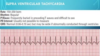 SUPRA VENTRICULAR TACHYCARDIA
 