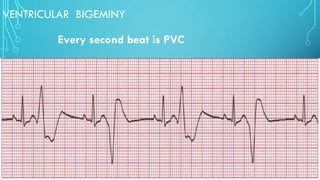 VENTRICULAR BIGEMINY
Every second beat is PVC
 