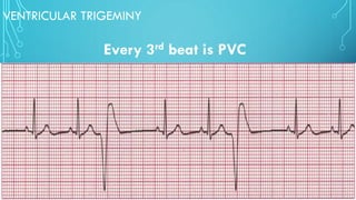 VENTRICULAR TRIGEMINY
Every 3rd beat is PVC
 
