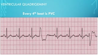 VENTRICULAR QUADRIGEMINY
Every 4th beat is PVC
 