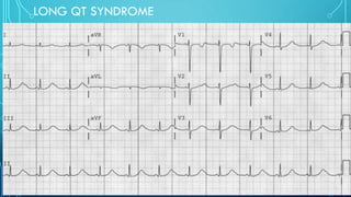 LONG QT SYNDROME
 