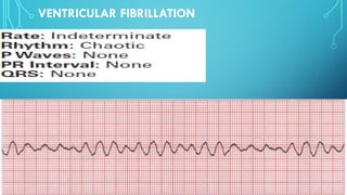 VENTRICULAR FIBRILLATION
 
