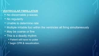 • VENTRICULAR FIBRILLATION
• No discernable p-waves
• No regularity
• Unable to determine rate
• Multiple irritable foci within the ventricles all firing simultaneously
• May be coarse or fine
• This is a deadly rhythm
• Patient will have no pulse
• begin CPR & resustication.
 
