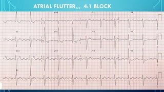 ATRIAL FLUTTER,,, 4:1 BLOCK
 
