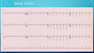 SINUS TACHY……
 