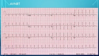 AVNRT
 