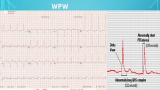 WPW
 