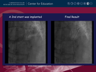 A 2nd stent was implanted

Final Result

 