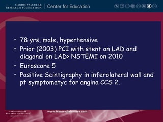 • 78 yrs, male, hypertensive
• Prior (2003) PCI with stent on LAD and
diagonal on LAD> NSTEMI on 2010
• Euroscore 5
• Positive Scintigraphy in inferolateral wall and
pt symptomatyc for angina CCS 2.

 