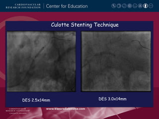 Culotte Stenting Technique

DES 2.5x14mm

DES 3.0x14mm

 