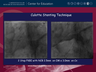 Culotte Stenting Technique

2 Step FKBI with NCB 2.5mm on OM e 3.0mm on Cx

 