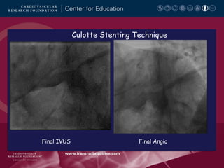 Culotte Stenting Technique

Final IVUS

Final Angio

 
