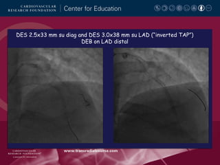 DES 2.5x33 mm su diag and DES 3.0x38 mm su LAD (“inverted TAP”)
DEB on LAD distal

 